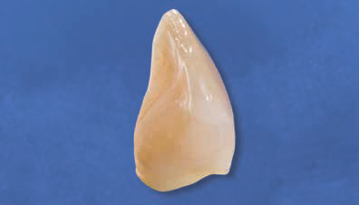 Ecusphere Shape A3 - после реставрации